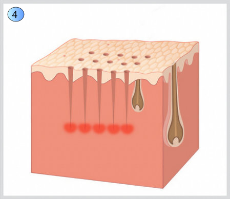 Illustratiion på microneedling i huden